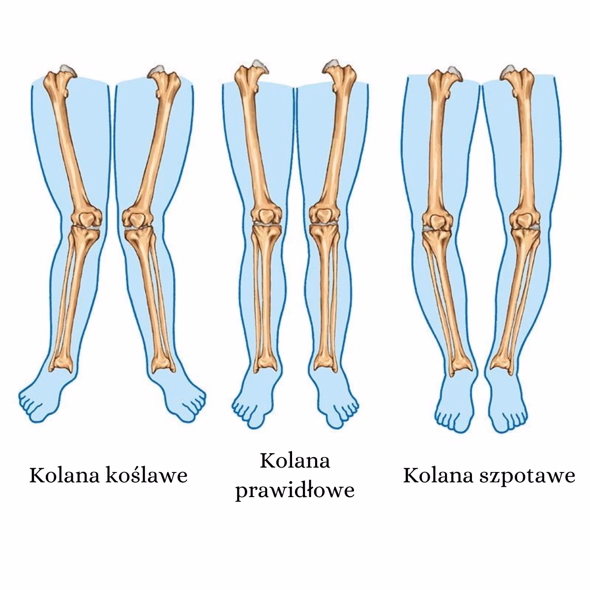 Jak sprawdzić, czy dziecko ma koslawe kolana?