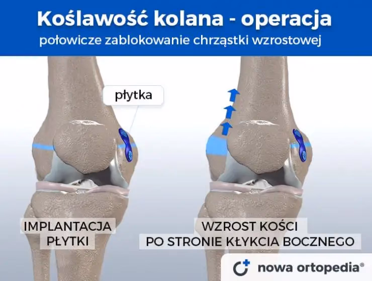 Od czego robi się koślawość kolan?