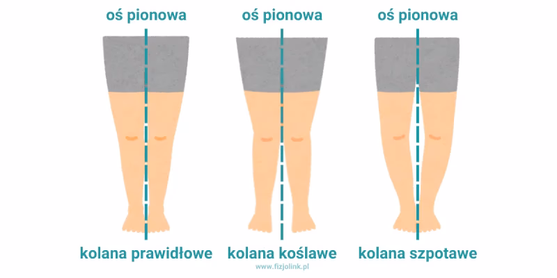 Czy można wyleczyć koślawość kolan u dzieci?